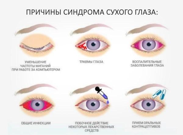 Причины синдрома сухого глаза
