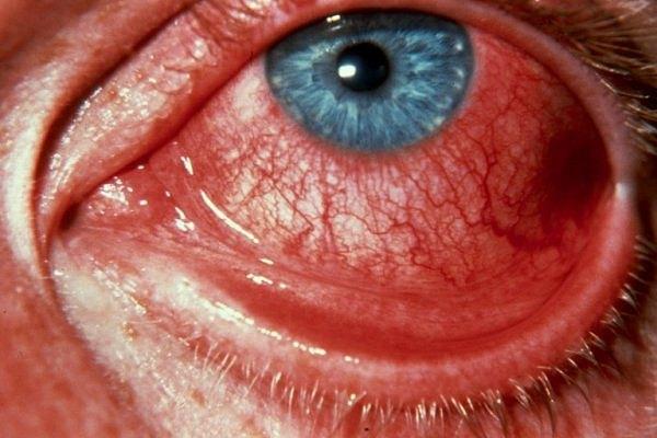 Геморрагический конъюнктивит глаза