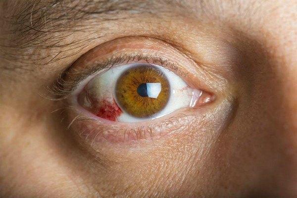 Заболевание ретинопатия