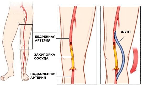 Шунтирование сосудов ног