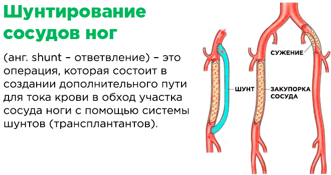 Шунтирование сосудов ног