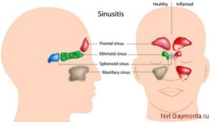 Симптомы и лечение синусита