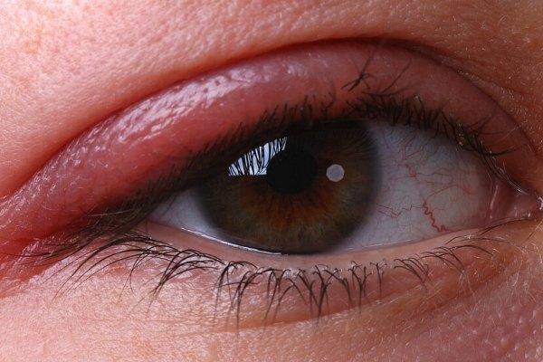 Аллергический блефарит глаз