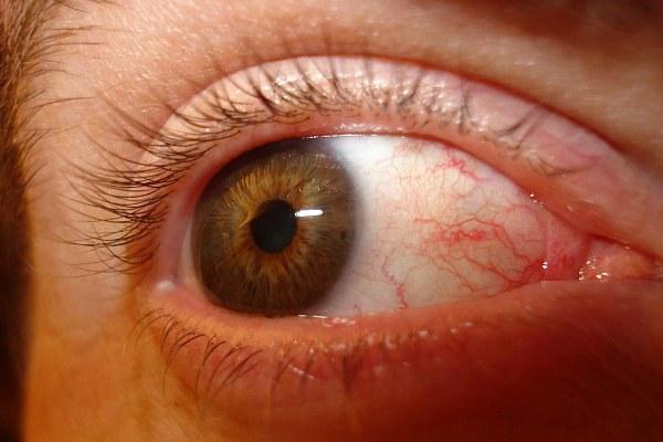 Усталость глаз при синдроме сухого глаза
