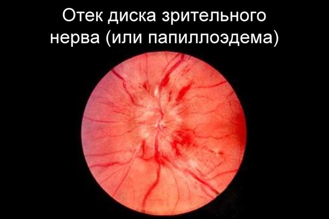 Отек диска зрительного нерва (папиллоэдема)
