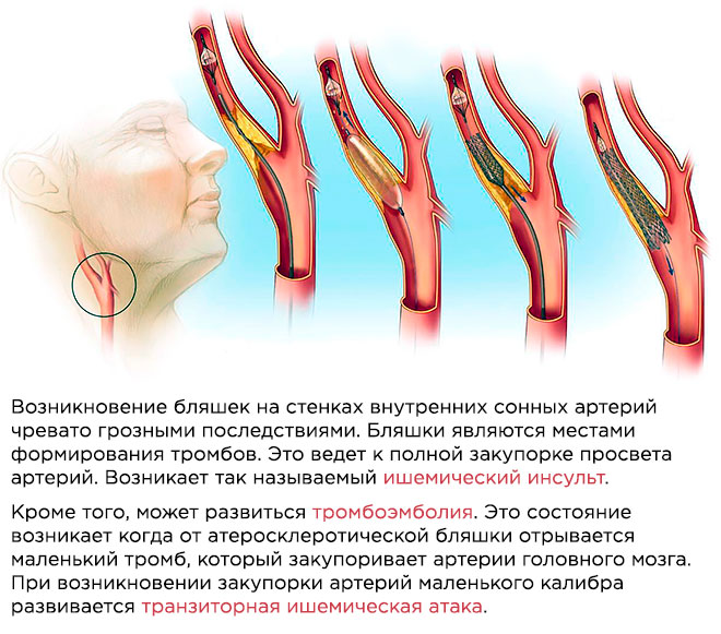 Стентирование сонных артерий