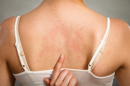 Аллергия на спине