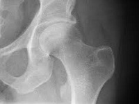Что такое остеома тазобедренного сустава