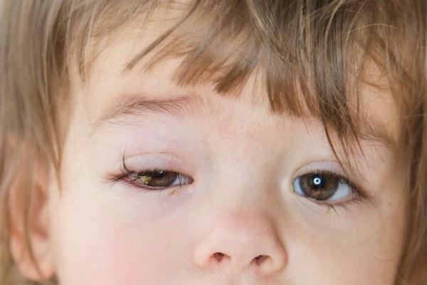 Острый конъюнктивит глаз у детей