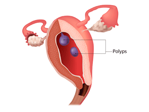 Типы железистых эндометриальных полипов