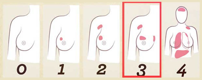 Поражения при третьей стадии рака груди