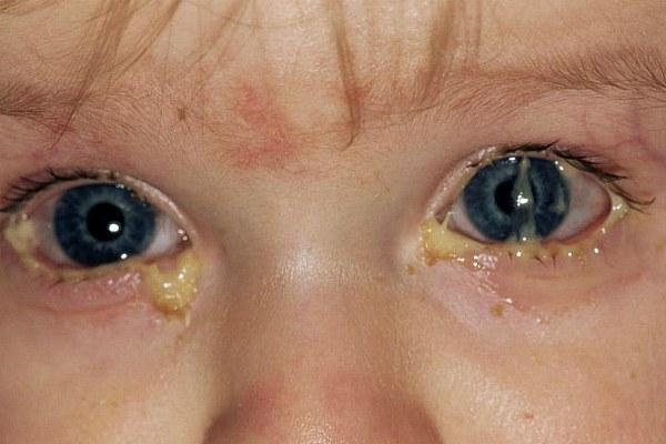 Хламидийное воспаление глаз у ребенка