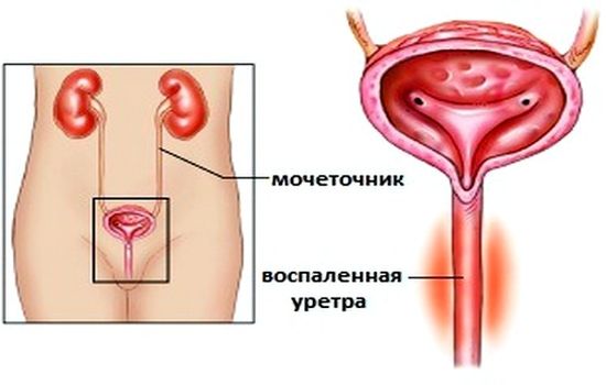 Почему может болеть мочевой пузырь у женщин и мужчин?