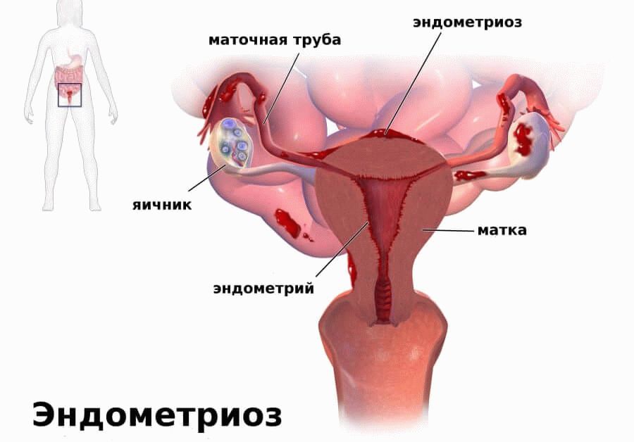эндометриоз матки