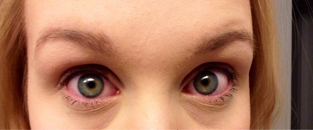 Как избавиться от аллергии глаз, возникшей после использовании туши для ресниц?