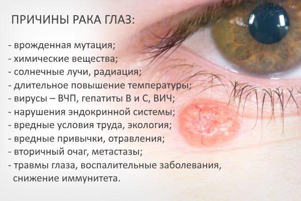 Причины онкологии глаз