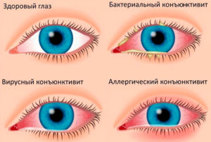 Виды глазной аллергии