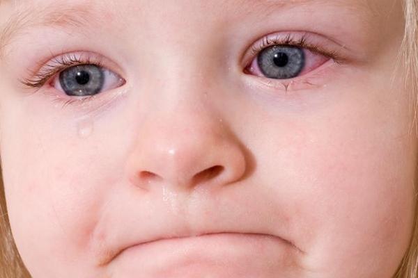 Вирусный конъюнктивит глаз у ребенка