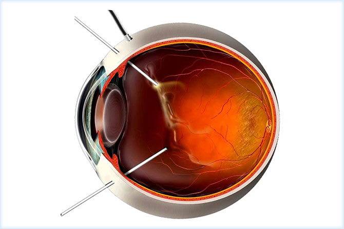 Отек сетчатки глаза после операции: как выявляется и лечится патология