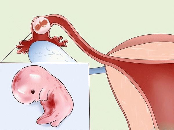внематочная беременность