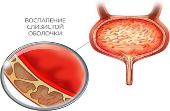 Признаки, диагностика и лечение цистита у ребенка