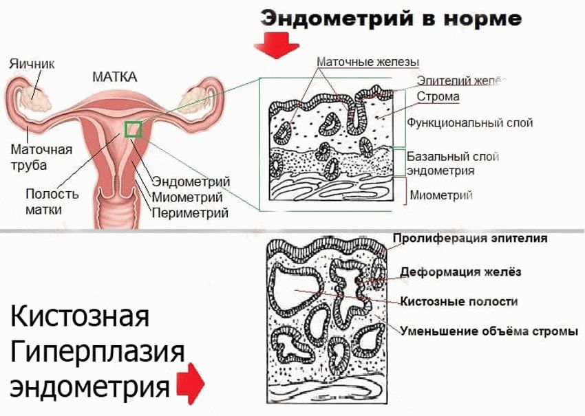 кистозная гиперплазия эндометрия