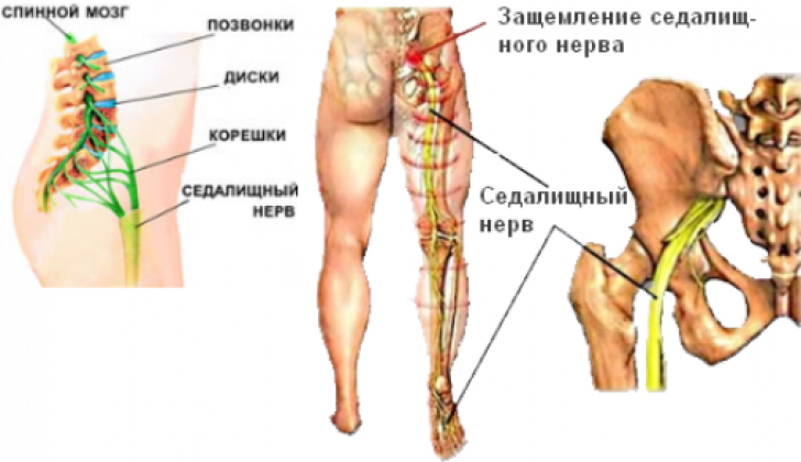 Седалищный нерв расположение рисунок