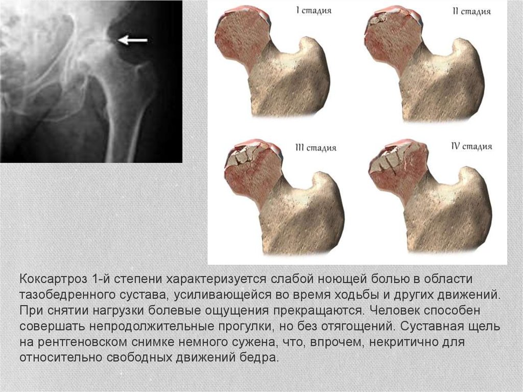 Схема лечения коксартроза тазобедренного сустава 2 степени