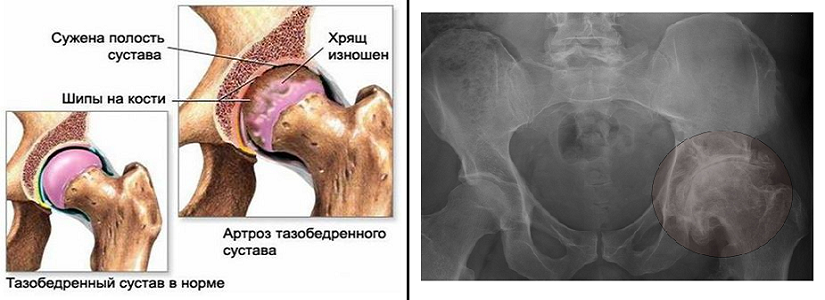 Остеоартроз тазобедренного сустава лечение. Артроза тазобедренного сустава коксартроза. Тазобедренный артроз 1 стадия. Коксо артроз бедренного сустава симптомы. Коксалгия тазобедренного сустава.