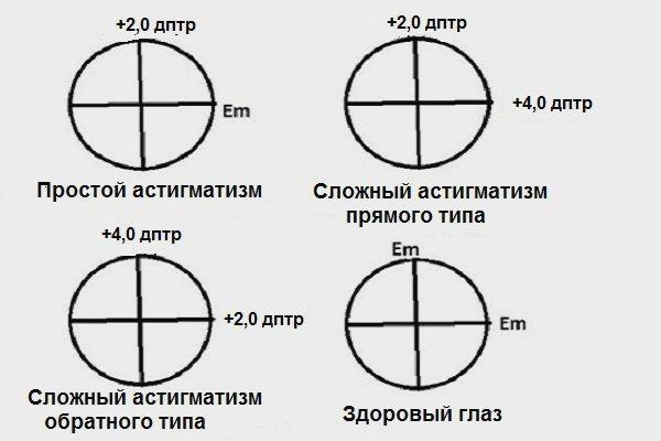 Степени астигматизма. Астигматизм 4.25. Сложный близорукий астигматизм. Степени астигматизма классификация. Миопический астигматизм классификация.