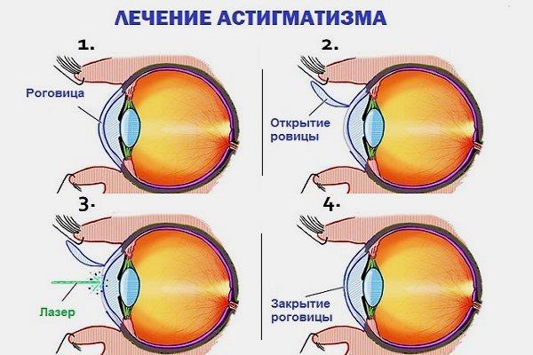 Астигматизм проверка по рисунку