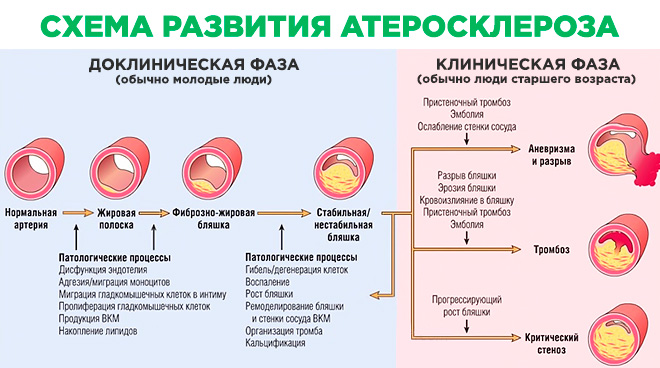 Стадии атеросклероза картинки