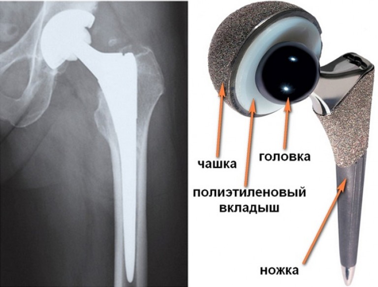 Титановый протез тазобедренного сустава