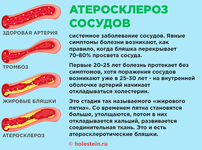 Признаки атеросклеротического поражения артерии