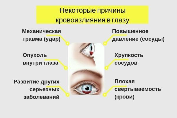 Глазами есть причина по. Кровоизлияние внутри глаза. Кровоизлияние в глаз причины. Кровоизлияние в угол глаза.