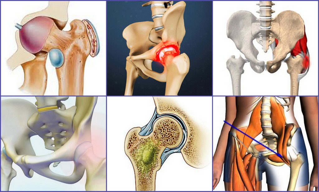 Тазобедренный сустав симптомы болезни лечение у женщин фото и лечение
