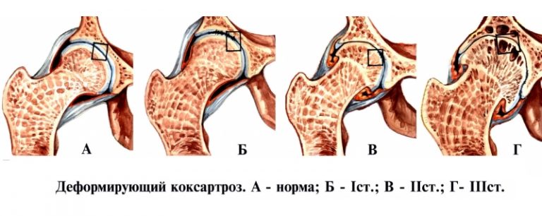 Коксартроз тазобедренного сустава 3 степени: симптомы и методы лечения болезни