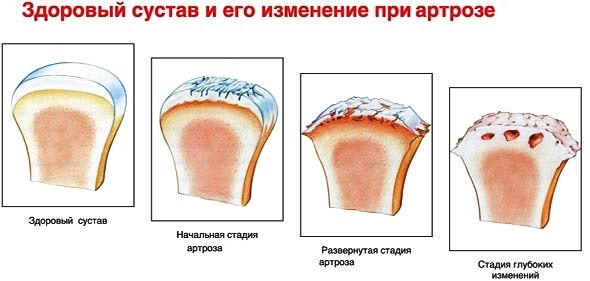 Коксартроз тазобедренного сустава 3 степени: симптомы и методы лечения болезни