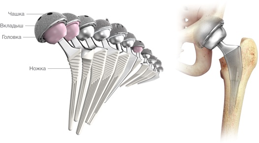 Сустав зиммер. Smith nephew эндопротез тазобедренного сустава. Тазобедренный эндопротез Зиммер. Коленный эндопротез Зиммер. Эндопротез ТБС Зиммер.