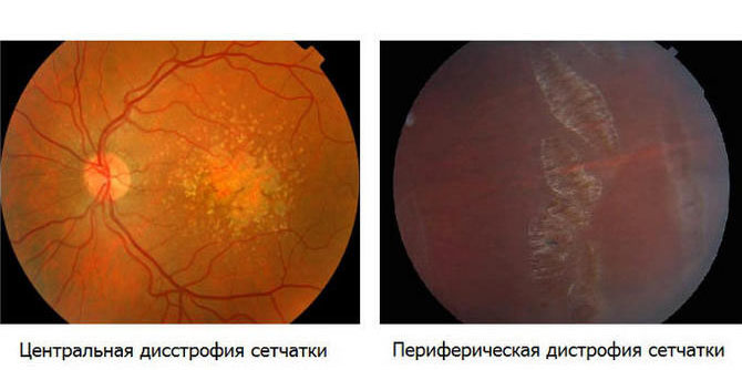 Диффузно атрофические изменения. Дегенерация центральной сетчатки глаза. Центральная дистрофия сетчатки глаза. Инеевидная дегенерация сетчатки. Серозная отслойка сетчатки.