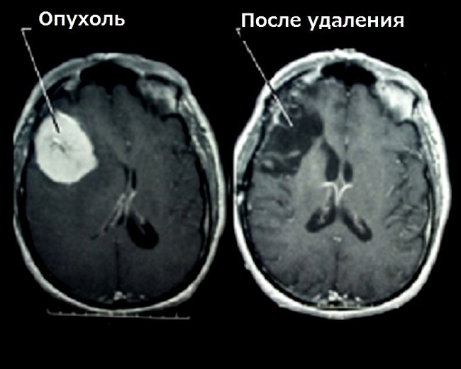 Рак головы симптомы. Доброкачественная злокачественная опухоль головного мозга мрт. Глиома головного мозга симптомы. Онкология,рак,опухоль головного мозга у детей. Опухоль головного мозга глиома.