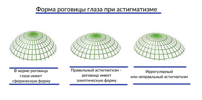 Астигматизм схема глаза