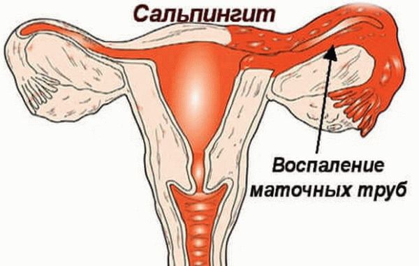 сальпингит