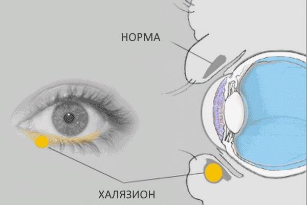 Халязион схема лечения