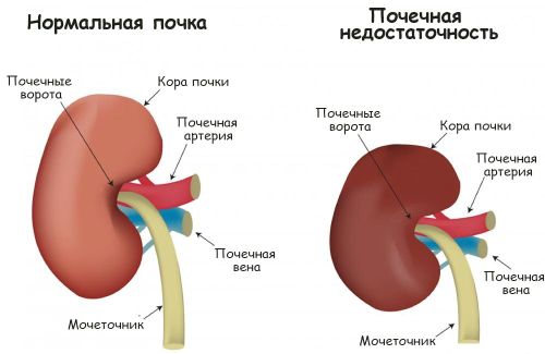 Что такое почечная недостаточность, как проявляется и лечится?