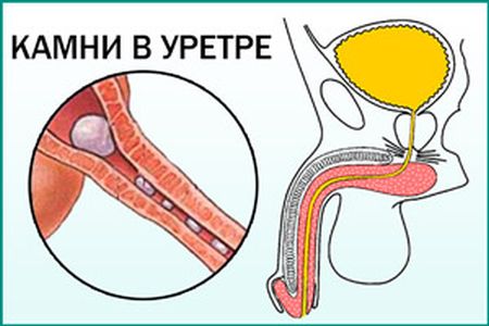 Камни при мочеиспускании как выглядят Жжение при мочеиспускании у мужчин - возможные причины и лечение стоматология-эл