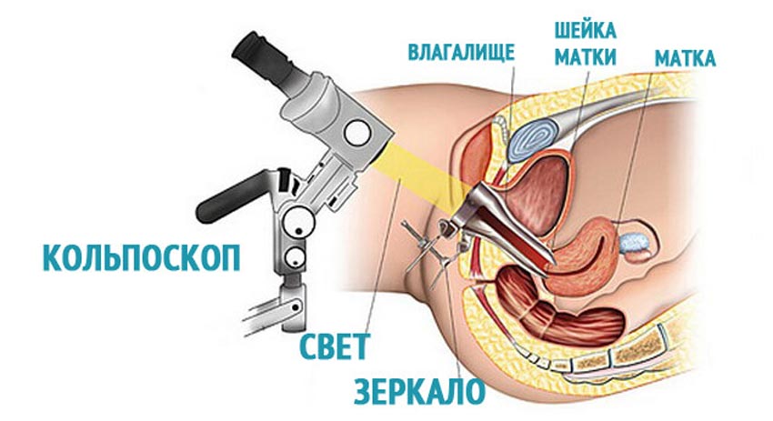 схема кольпоскопии