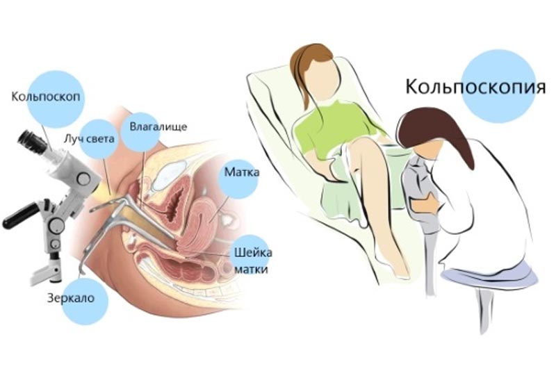 проведение кольпоскопии