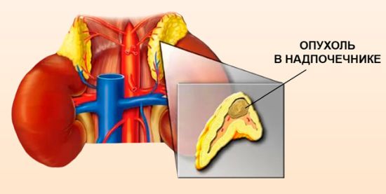 Симптомы заболеваний надпочечников, их диагностика и лечение