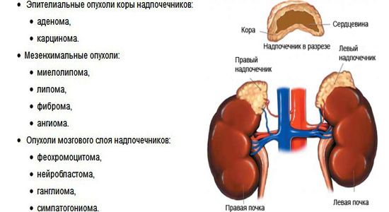 Что такое аденома надпочечников, как она проявляется и лечится?